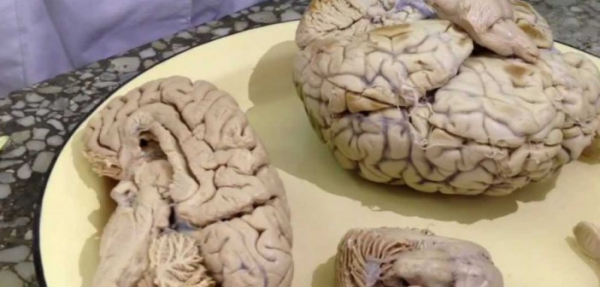 Признаки сужения сосудов головного мозга